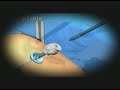 Single Incision Laparoscopic Surgery