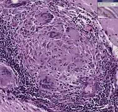 brain tumour more condition_symptoms