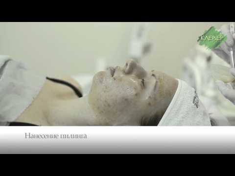 Механическая чистка лица Механическая чистка лица