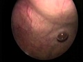 Closed Technique for Suprapubic Catheter Placement