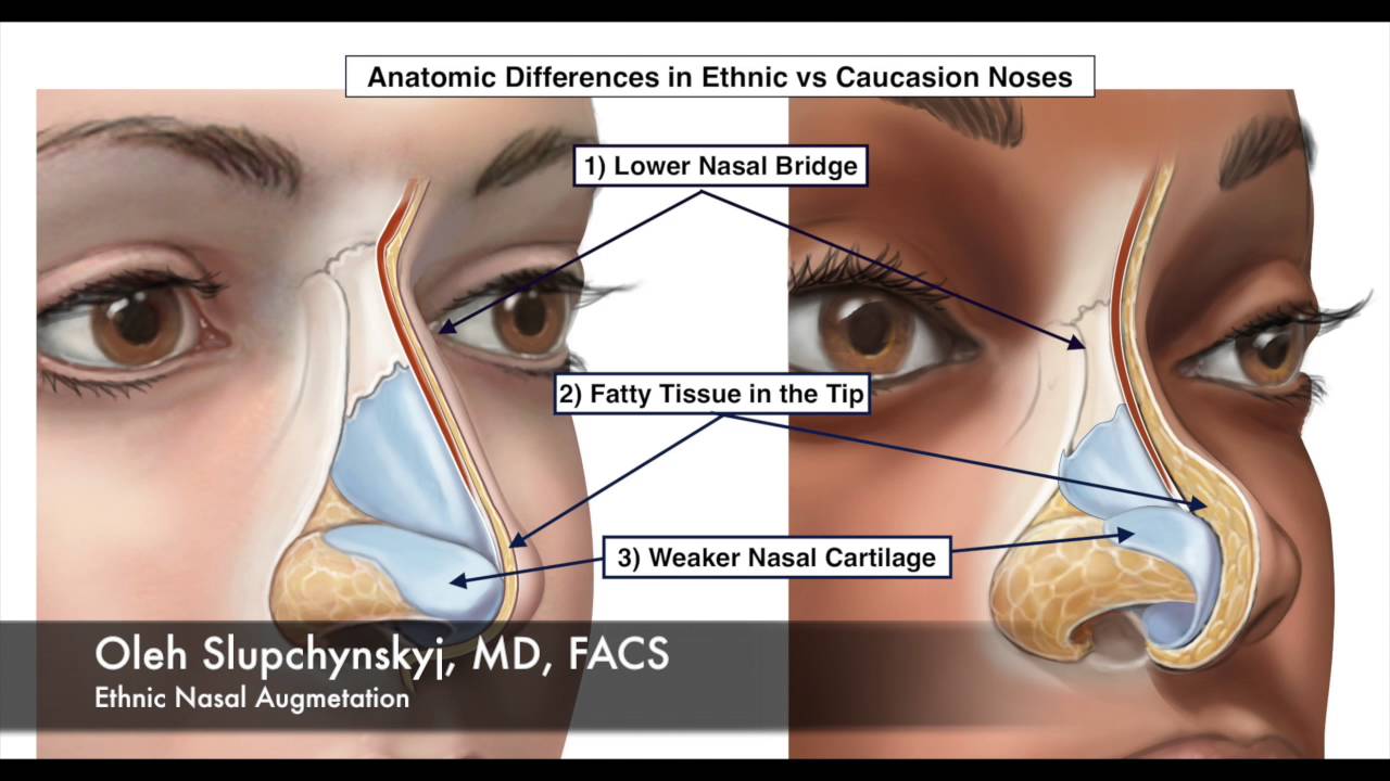 Asian nose bridge