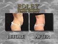 Abdominoplasty / Tummy Tuck Surgery Video