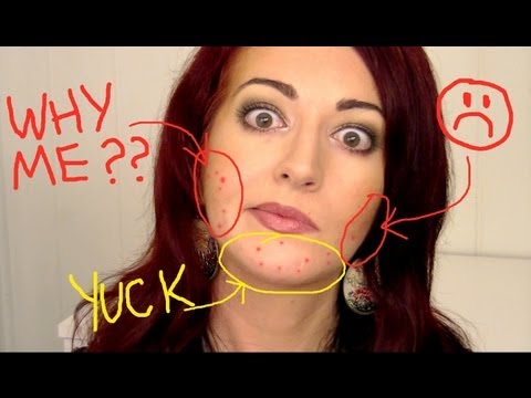 Acne Face Charts &amp; Mapping? Hormonal Acne &amp; More Clear Acne Quick Tips 