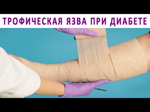 Трофические язвы стопы лечение в домашних условиях
