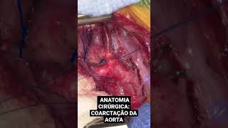 Anatomia Cirúrgica na Coarctação da aorta.