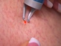 Awesome video showing varicose vein removal