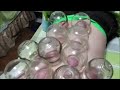 Traditional Chinese Medicine TCM Cupping Schröpfen in China 拔罐子 カッピング療法 Ventosaterapia