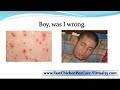 chicken pox home remedies - fast chicken pox cure - how to treat chicken pox