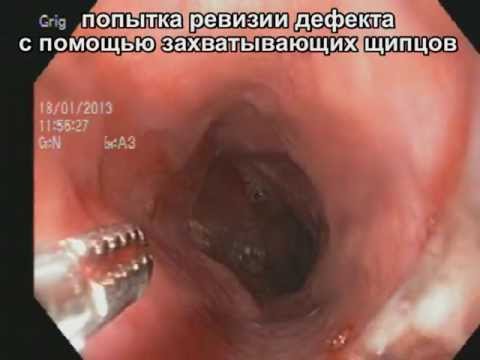 Застряла кость в горле как вытащить в домашних условиях Застряла кость в горле как вытащить в домашних условиях