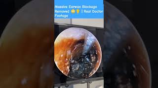 Mive Earwax Blockage Removed Real Doctor Footage