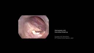 Hemostasis With Hemostat Widecup