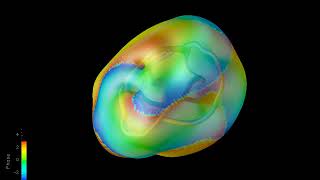 Vortex Dissipative Optical Soliton Knots Are Untying.