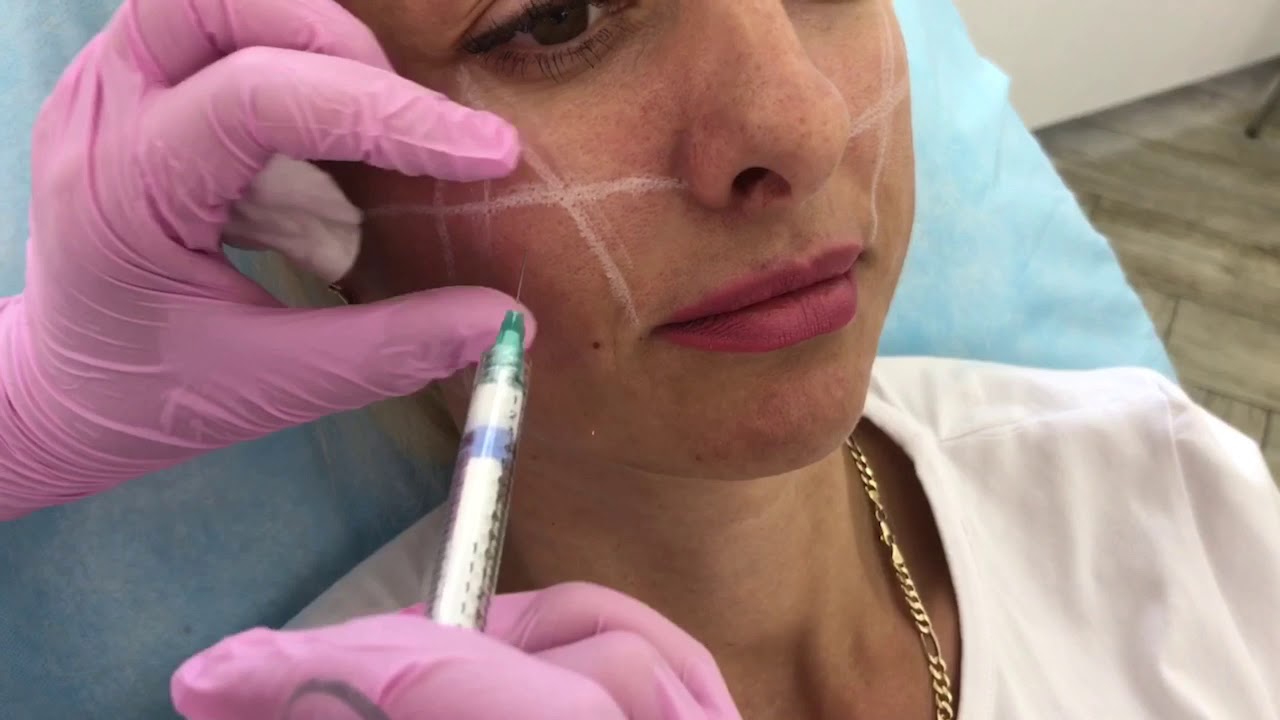 Radiesse facial filler globular filler opinions