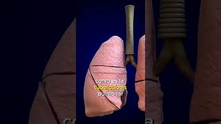 Derrame Pleural, Sus Causas Sistémicas Y Exudativas.