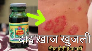 जलम लशन क सचचई जनकर हश उड जयग Ringworm Fungal Itching Eczema Full Information