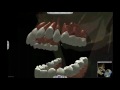 3D TMJ Simulation