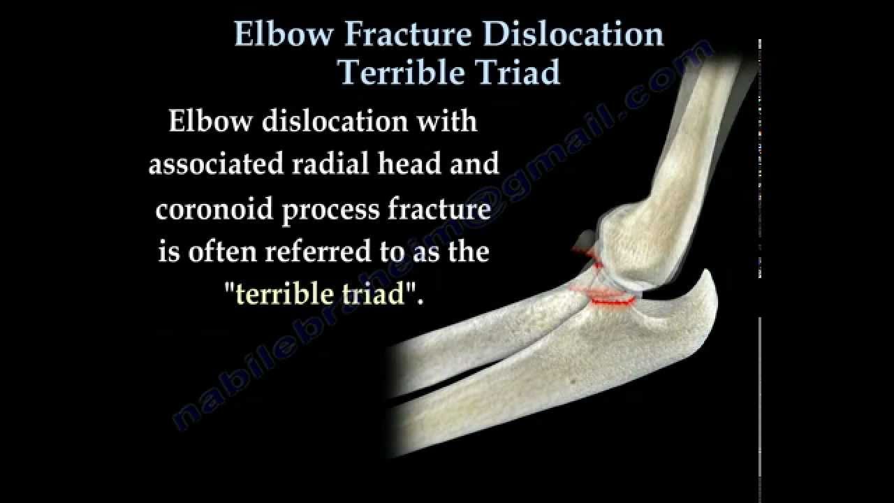 Elbow Fracture Dislocation Terrible Triad - Everything You Need To Know