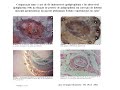 hernioplastia