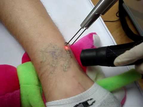 Tags:laser tattoo removal air cooled no numbing cream numb cream Tags:laser tattoo removal air cooled no numbing cream numb cream