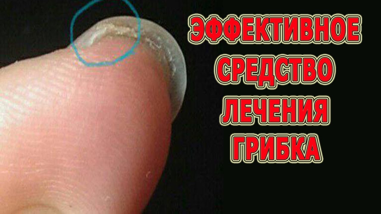 Ютуб как лечить грибок 116