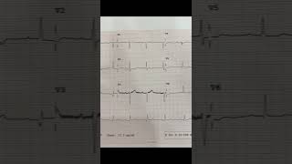 Ecg Diagnosis Cvs Dr Arvind Kumar