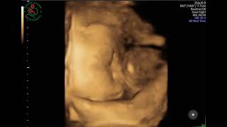 Ade Bayi Umur 32 Minggu Dalam Perut Mamah