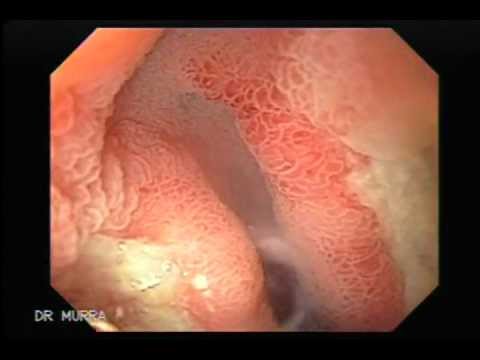 La homeopatía atopicheskogo de la dermatitis