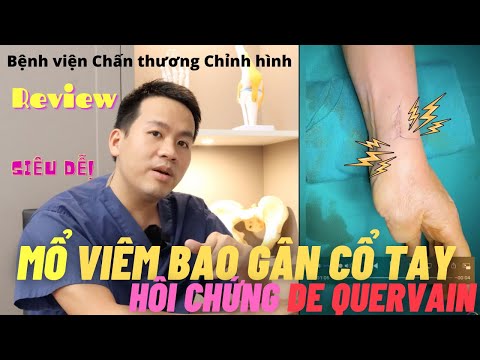 Toàn bộ quá trình phẫu thuật hội chứng de quervain đơn giản và các câu hỏi liên quan