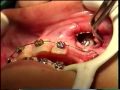 cirugía dental