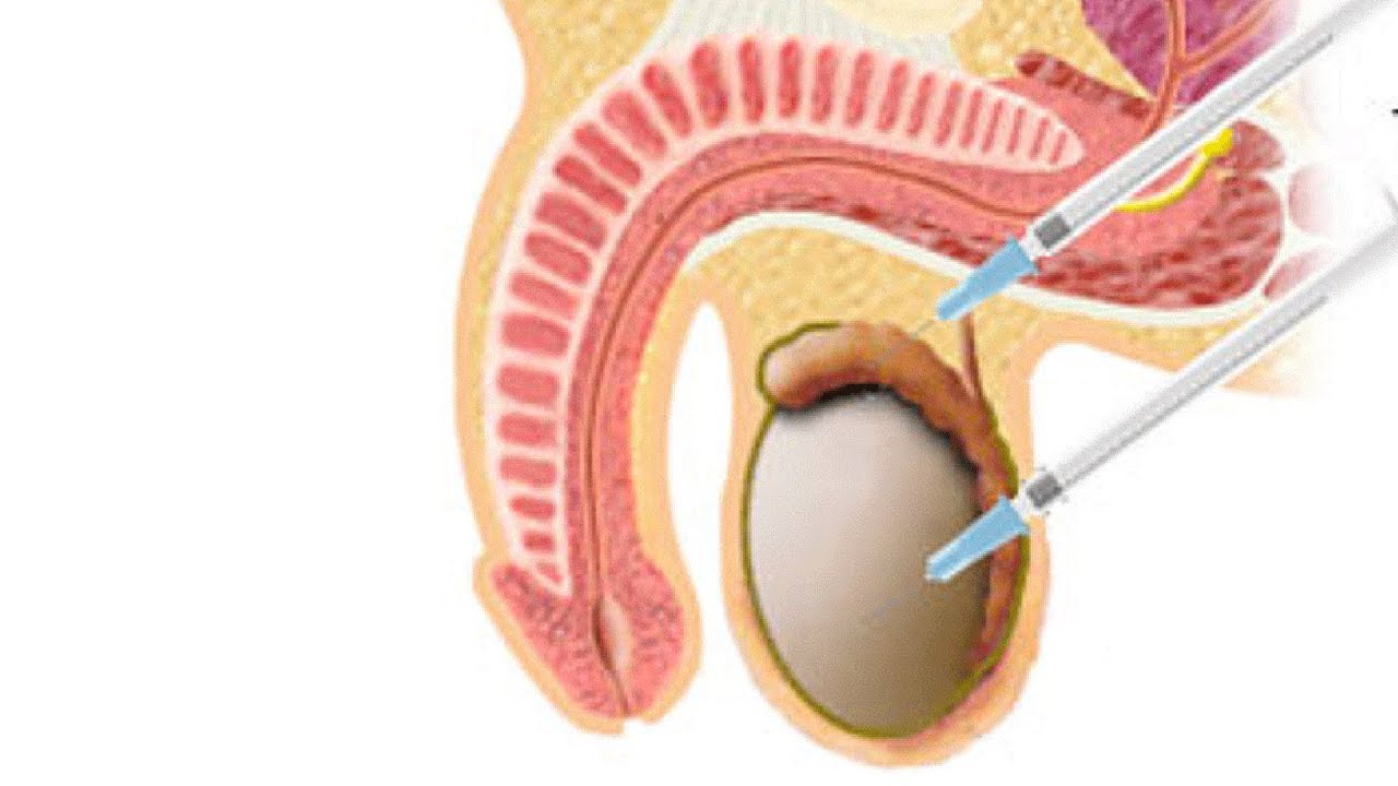 Epididymal sperm aspiration