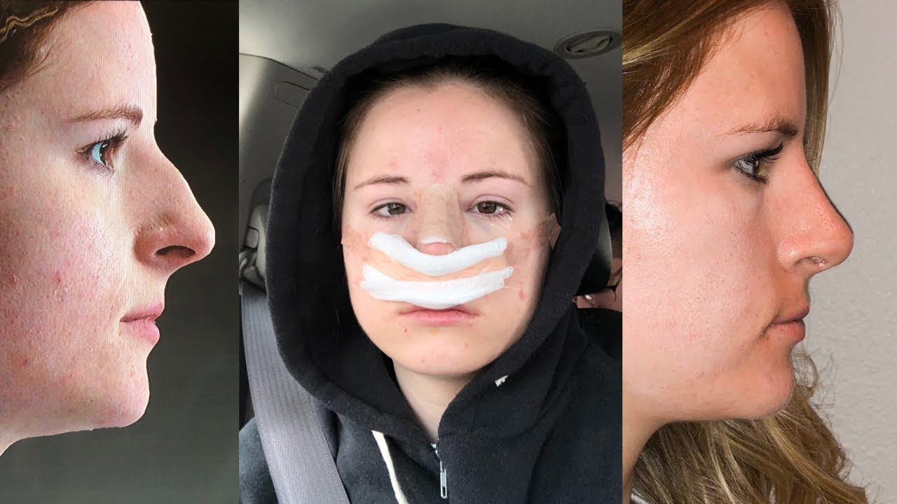 Meghan Rienks Nose Job Before And After.