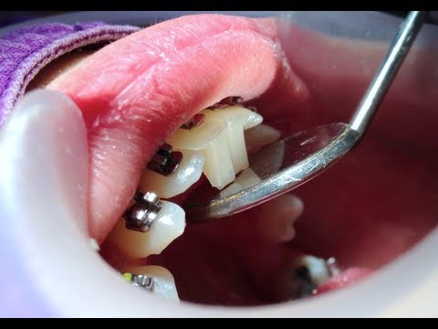 Как сделать искусственные брекеты Как сделать искусственные брекеты