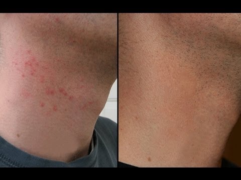 HOW TO CURE RAZOR BURN BUMPS ON NECK &amp; LEGS! - YouTube