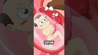 The Hidden Risk Of A Previous C Section.