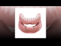 Implant Supported Dentures - Calgary Implant Dentures