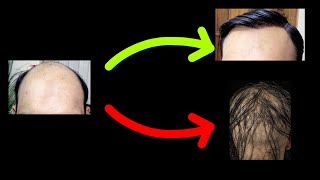 Trasplante sintético ¿Pelo ilimitado o complicación habitual?