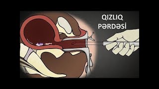 İlk cinsi əlaqədə qanama mütləq olmalıdır? -  QIZLIQ PƏRDƏSİ