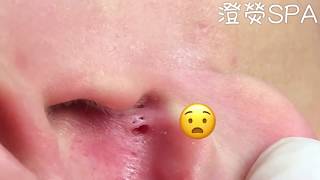 123456—黑頭粉刺?