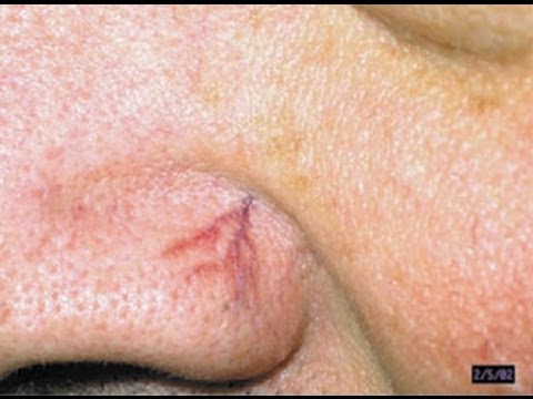 ebony milk squirt gif broken capillaries facial