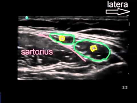 lateral femoral cutaneous nerve - YouTube