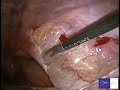 hernioplastia