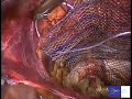 hernioplastia