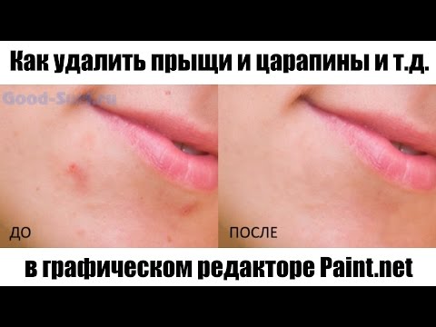 Как убрать прыщи самой Как убрать прыщи самой
