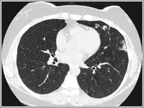 Extrinsic Allergic Alveolitis