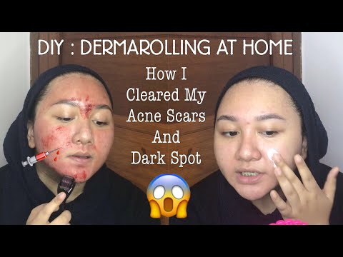 DIY : DERMAROLLING AT HOME | Cara memudarkan Bopeng Bekas Jerawat | Bahasa Indonesia | Diendiana - YouTube
