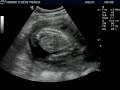 Baby Girl Ultrasound - 19 Weeks