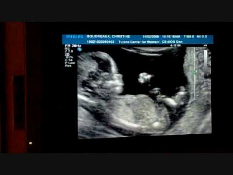 13 weeks 1 day Sonogram. ultrasounds at 13 weeks. 13 weeks 1 day Sonogram.