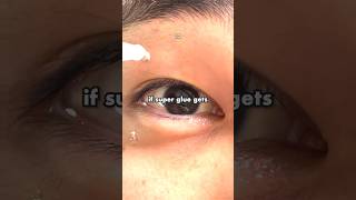 How To Survive Superglue In Your Eye