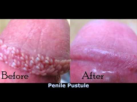 That for small white bumps on the penis