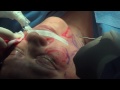 Miami Plastic Surgery - Facelift with Fat Grafting Surgery with Dr. Michael Kelly